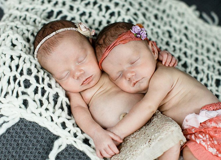 Como estão agora as gémeas que nasceram de mãos dadas, e emocionaram a web