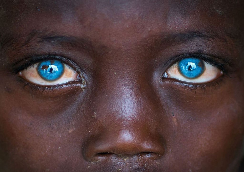 Doença genética faz com que este menino tenha os olhos com uma cor fascinante