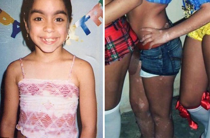 Era vítima de bullying por ter manchas na pele, e agora usa o corpo para fazer obras de arte