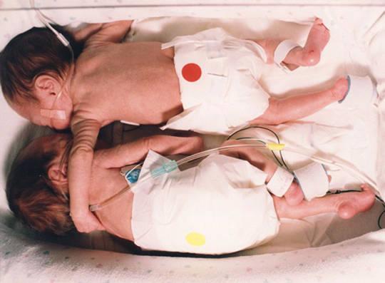 Esta bebé estava a lutar pela vida, a enfermeira colocou-a junto da irmã gémea e um &#8220;milagre&#8221; aconteceu!