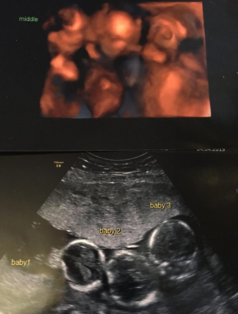Mãe deu à luz tri-gémeos &#8220;especiais&#8221;, e que surpreenderam os médicos