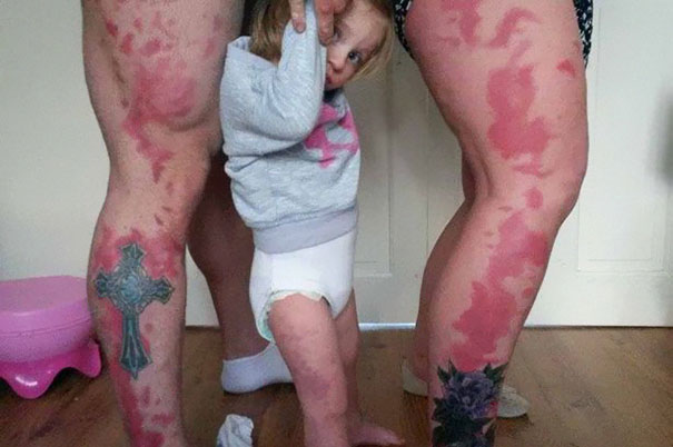 Pais tatuam marcas de nascença para ajudar filha.
