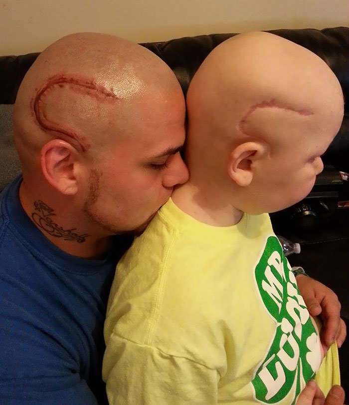 Pai tatua cicatriz do filho operado a um tumor no cérebro, para o ajudar a ganhar confiança