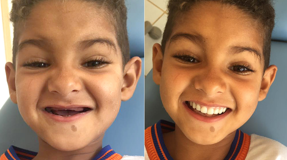 Dentista realizou o sonho deste menino: ter dentes como os colegas