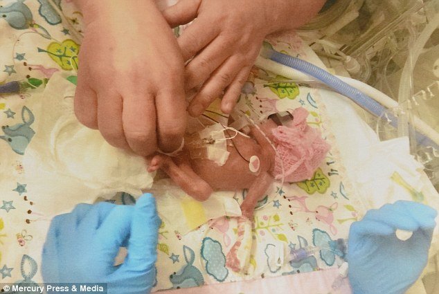 Bebé que nasceu com apenas 600 gramas sobreviveu, e tem agora 9 meses