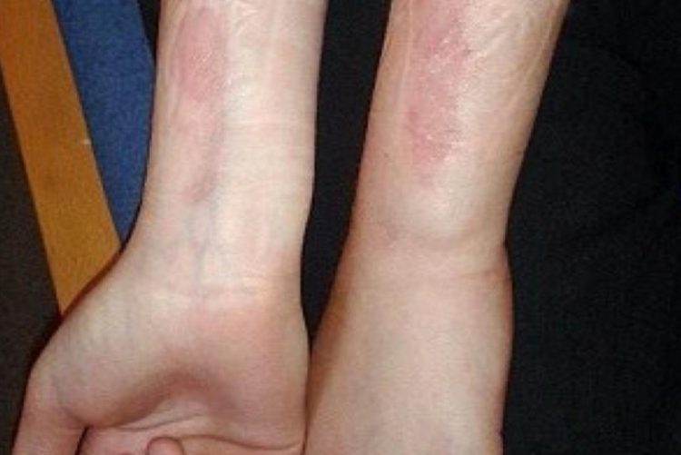 Novo desafio viral entre os jovens está a causar lesões graves na pele