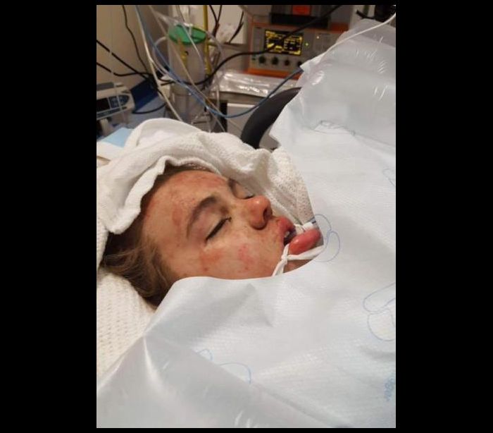 Mãe partilha foto da filha em coma para alertar para os efeitos do esctasy