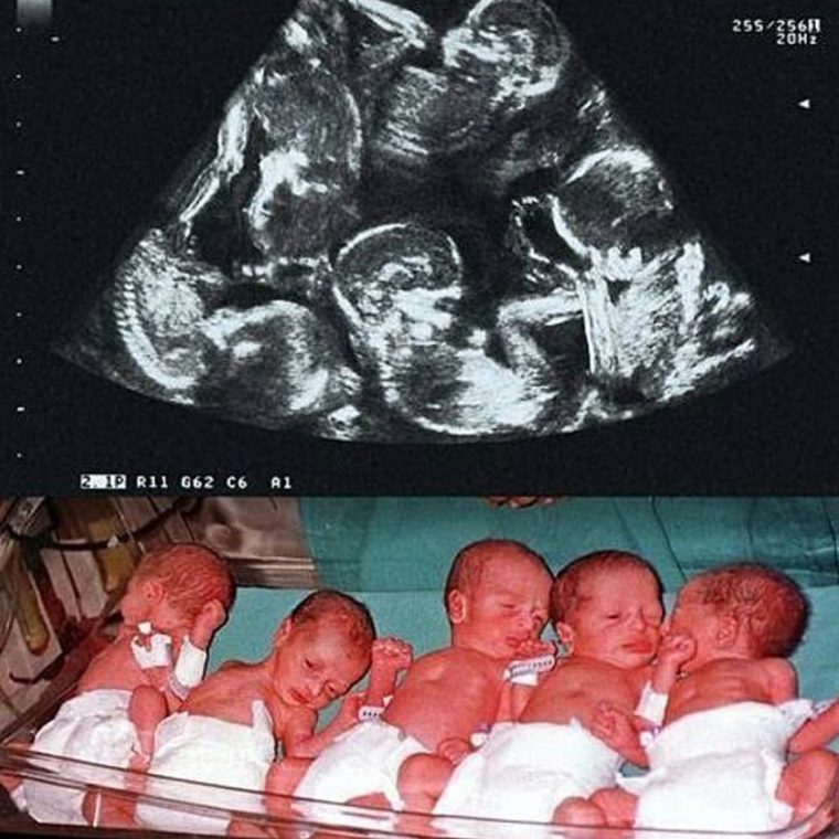 Ela pensava que ia ter 2 gémeos, e teve 5 filhos. Olha como estão agora&#8230;