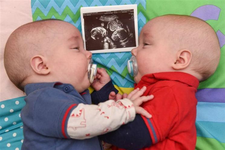 Gémeos ficaram abraçados no útero, e sobreviveram a gestação de risco