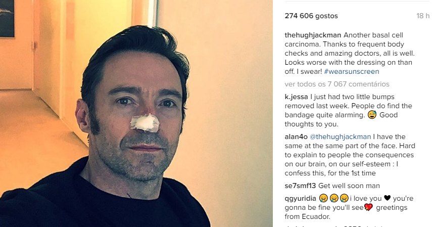 Hugh Jackman retira tumor no nariz e deixa um alerta nas redes sociais