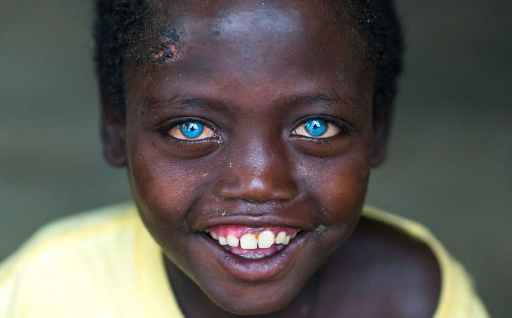 Doença genética faz com que este menino tenha os olhos com uma cor fascinante