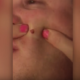 Esposa espreme borbulha que o marido tinha na cara há 4 anos