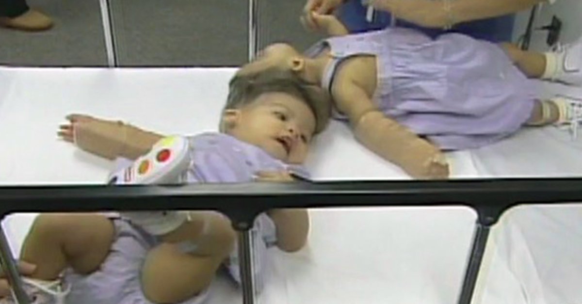 Mãe dá à luz gémeas unidas pela cabeça. 15 anos depois estão tão diferentes