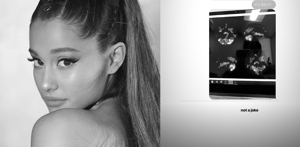 Ariana Grande revela imagem do cérebro, após o atentado: &#8220;Hilariante e aterrorizador&#8221;