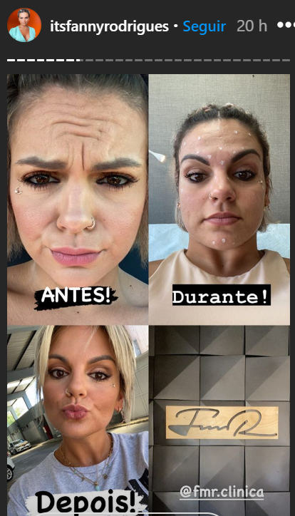 Fanny Rodrigues coloca botox no rosto. Veja o antes e o depois!