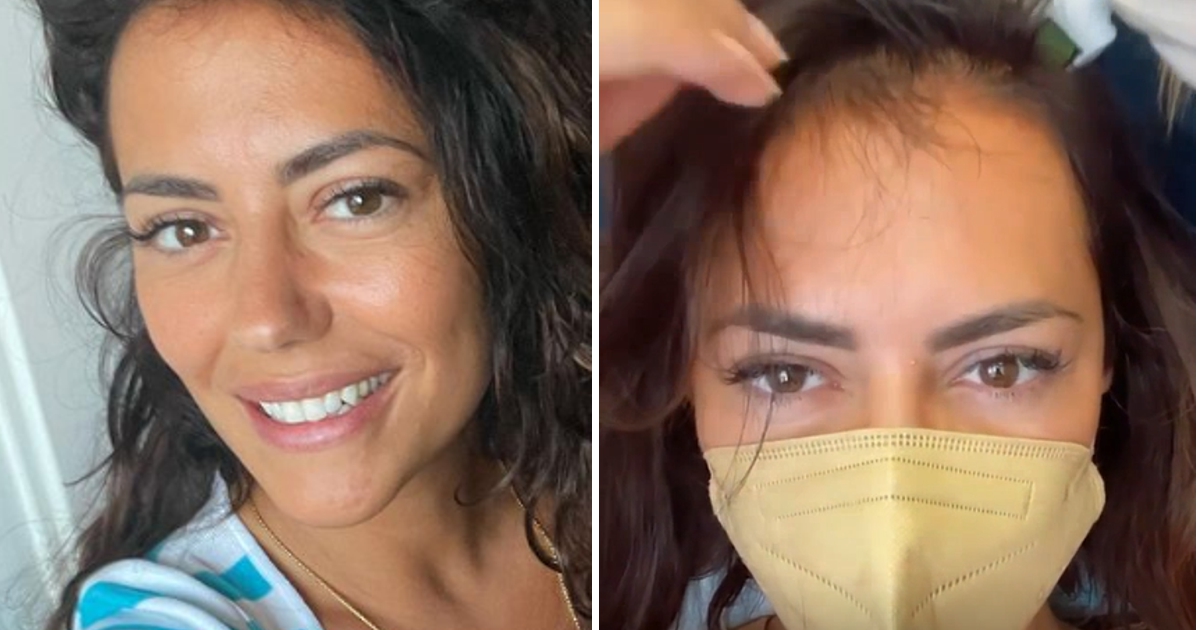 Sofia Ribeiro faz implante de cabelo e revela processo: &#8220;E já se nota o cabelinho novo&#8230;&#8221;