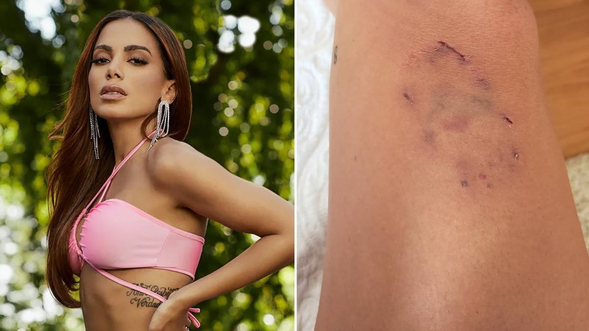 Anitta é atacada pelos seus cães e mostra ferimentos: &#8220;Sobrou para mim&#8221;
