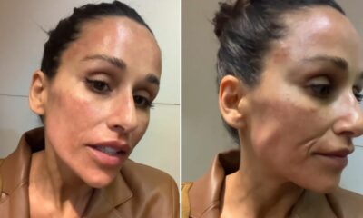Rita Pereira submete-se a tratamento e fica com manchas no rosto: &#8220;Estou nem aí&#8221;