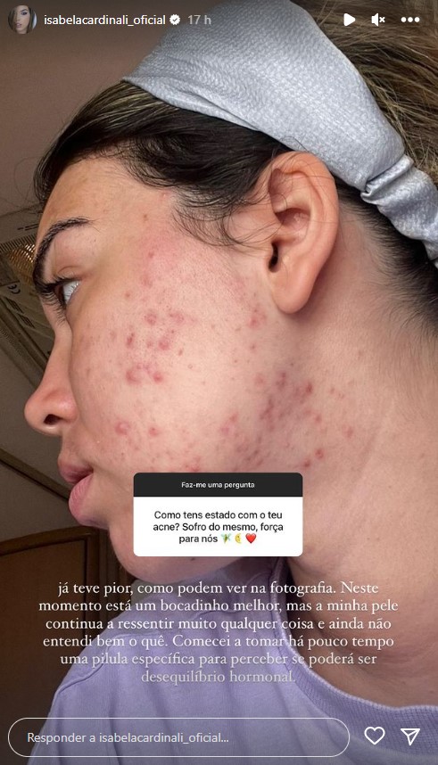 Isabela Cardinali mostra a cara com acne e revela: &#8220;Já teve pior, como podem ver&#8230;&#8221;